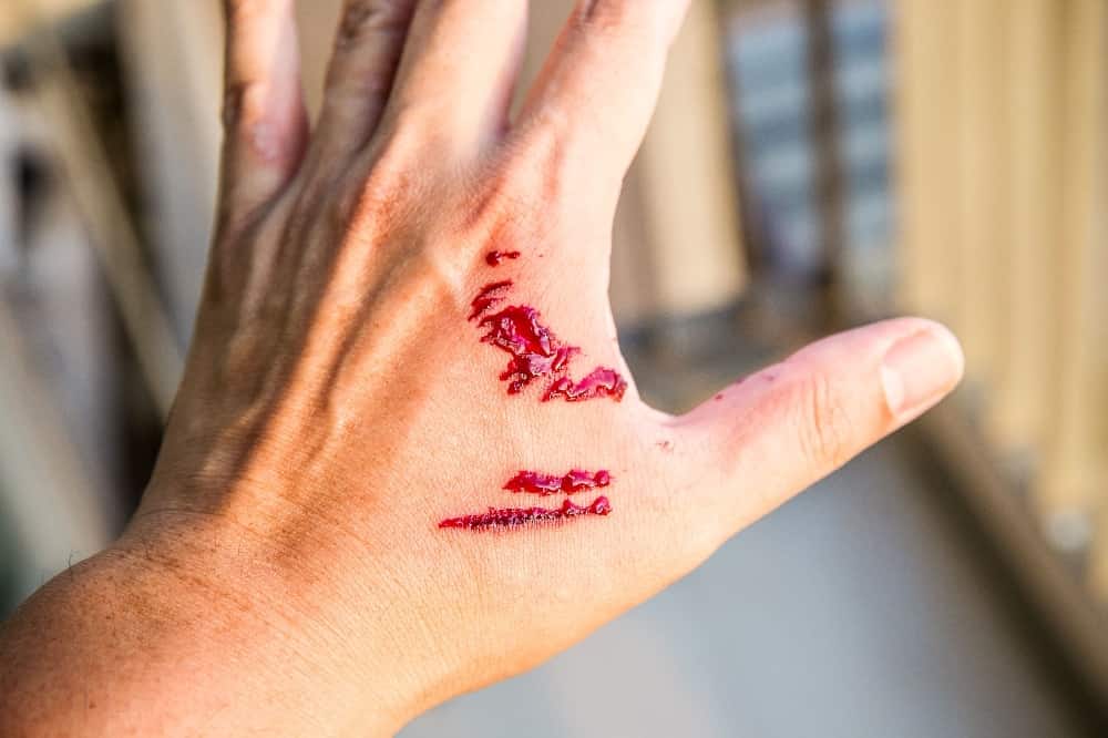 Photo illustration of a dog bite. An experienced attorney can help file a dog bite claim and get on the road to recovery.
